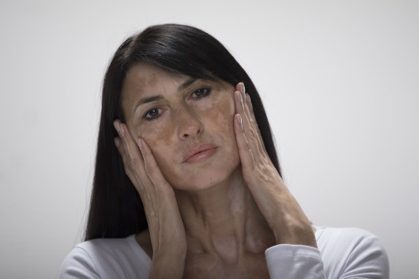 美丽的白种人妇女皮肤问题白癜风图片下载