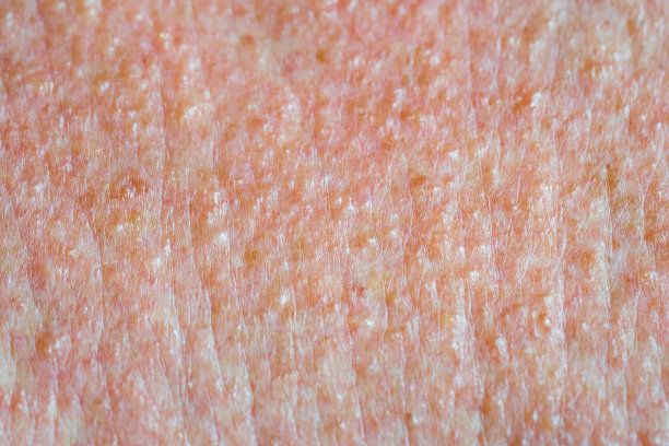 皮肤质地疼痛，有红色水疱，化学烧伤后出现皮疹图片下载