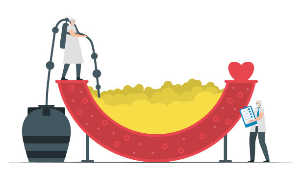 医生在血管里吸脂肪。冠状动脉疾病治疗。在白色背景上分离的心脏病矢量插图。图片下载