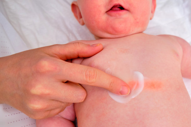 妈妈在她的婴儿皮肤过敏点上涂奶油图片下载