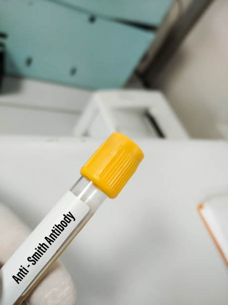 血液样本用于抗史密斯抗体测试，SLE和MCTD的诊断和监测，图片下载