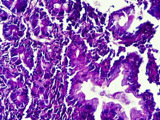 人鳞状细胞癌，显微镜下200倍放大的显微照片全景图图片下载