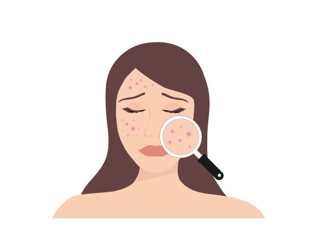 脸上长粉刺，用放大镜放大。痤疮皮肤面部问题概念图片下载