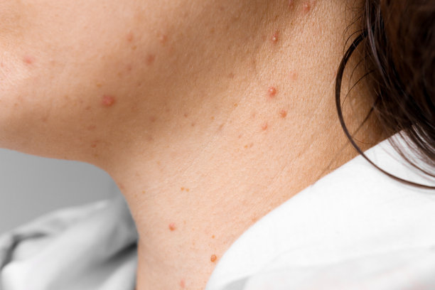 女人的脸和脖子与问题皮肤和丘疹特写。十几岁的红丘疹，护理与美容理念。图片下载