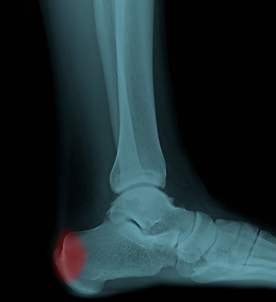 足部和踝关节侧位x光片。影片显示正常的骨骼和关节。患者患有跟腱炎和跟骨后粘液囊炎。图片下载