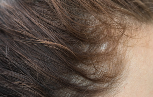 女性脱发，头发弱而稀疏。图片下载