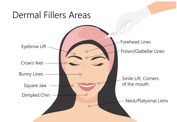 皮肤填充物和肉毒杆菌注射区域。妇女面对医生手在手套与注射器。美容提升抗衰老治疗矢量插图。图片下载