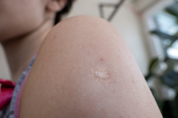 一位年轻女士右臂上的针痕特写图片下载