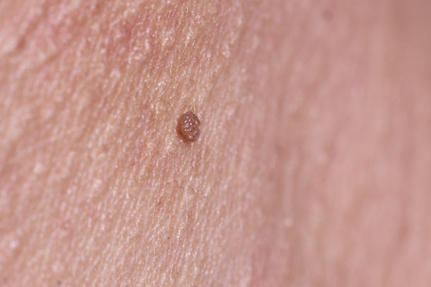 人类皮肤上的乳头状瘤图片下载