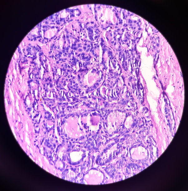 甲状腺组织中腺瘤性改变的结节性甲状腺肿的显微照片（显微图像），40倍视野图片下载