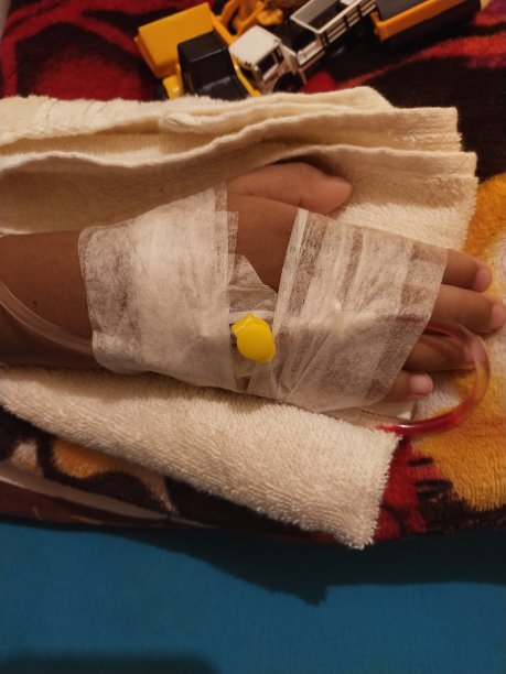 印度尼西亚雅加达，2021年11月7日，IV软管手。因为登革热而被注射的手的照片图片下载