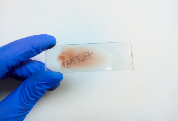 戴着蓝色手套的技术员手持血液涂片进行血液学分析。加拿大广播公司图片下载