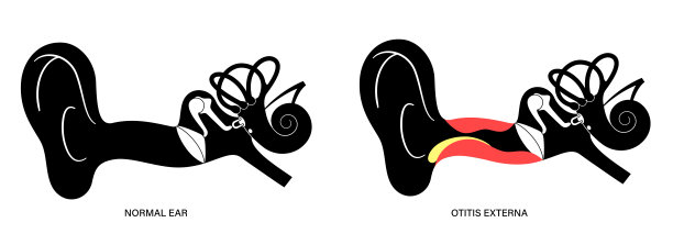 游泳耳耳炎图片下载