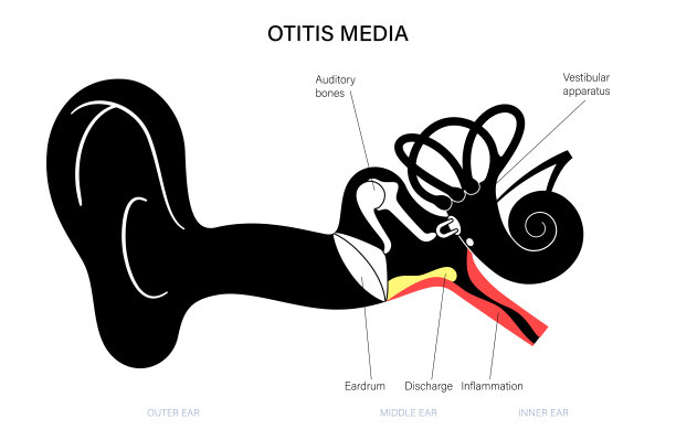 中耳炎疾病图片下载