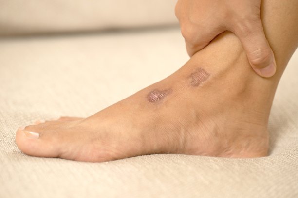 瘢痕疙瘩是一种隆起的疤痕，比原来的疤痕大。这是由组织肥大引起的，被认为是该区域的一个厚凸起图片下载