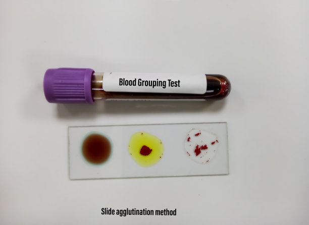 玻片凝集法验血，B型阳性。医学的概念图片下载