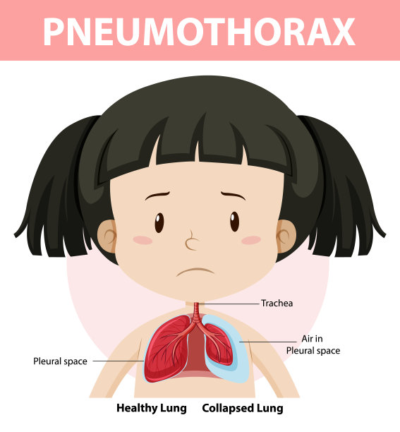 人体解剖气胸图图片下载