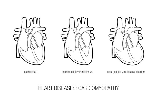 心脏病概念中平体，矢量图片下载