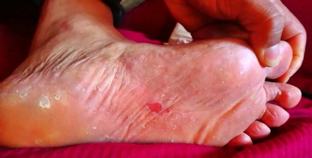 人向医生展示受伤的脚图片下载