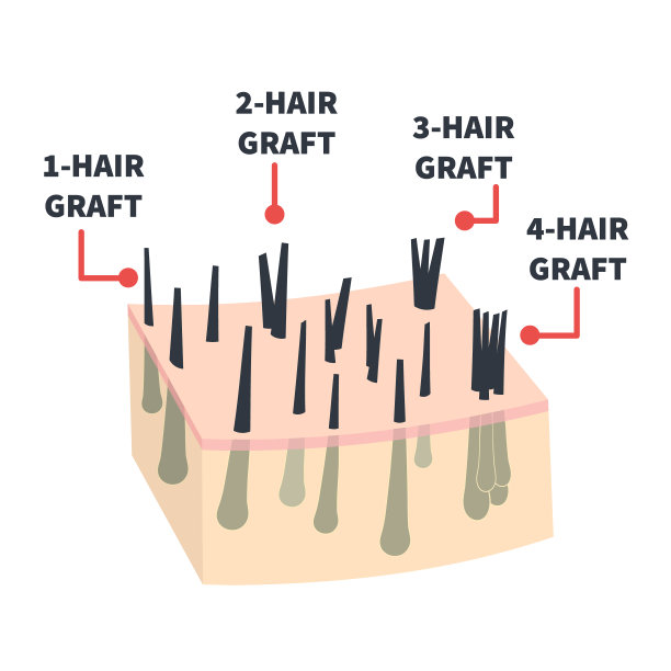 植发类型为头发移植设置图片下载