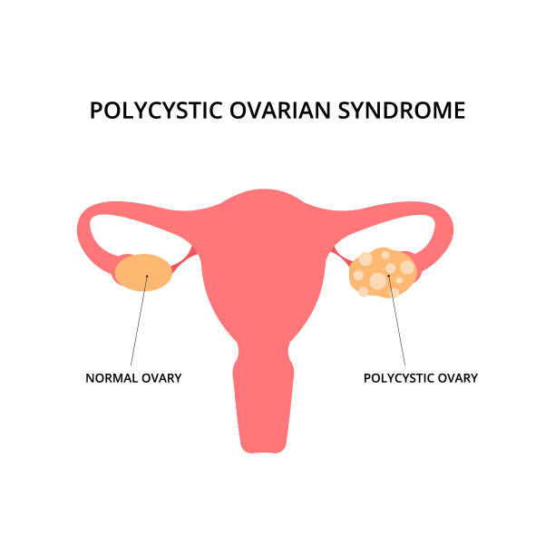 多囊性卵巢综合征图片下载