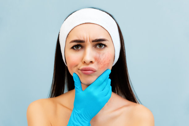 一个年轻的沮丧的女人的肖像，脸颊上有红色的炎症和血管，用蓝色医用手套托着下巴。美容与酒渣鼻的概念图片下载