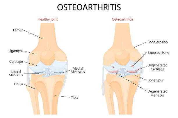 膝关节骨关节炎及正常关节详细解剖。骨关节炎。关节炎或关节内的疼痛。退化性关节疾病。软骨磨损。矢量平面设计图片下载