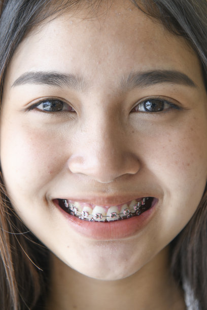微笑的年轻女人戴着牙套的特写镜头图片下载