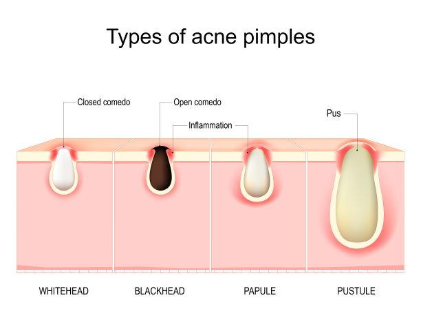 粉刺的类型。人体皮肤的横切面图片下载