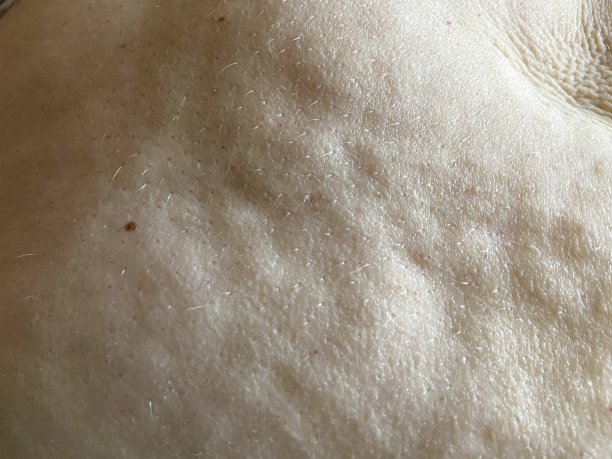 脂肪团纹理皮肤背景表面图片下载