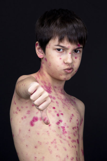 儿童的皮疹。水痘病毒。拇指向下图片下载