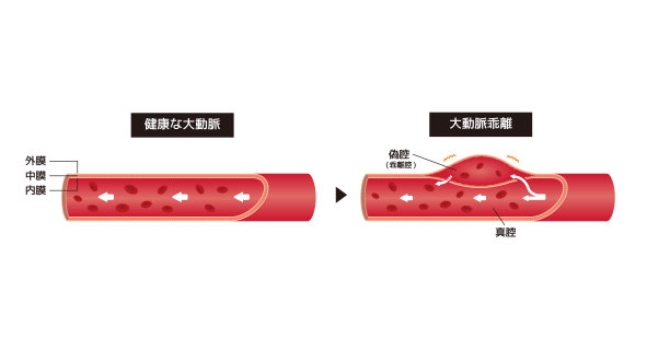正常主动脉与主动脉夹层对比图(日语)图片下载