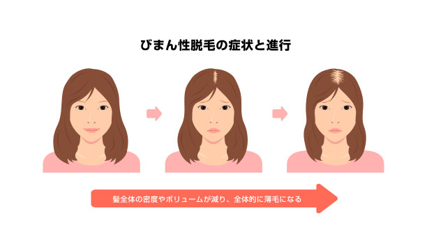 女性雄激素性脱发研究进展。矢量图图片下载