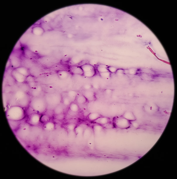 腕关节(FNA):神经节细胞，镜下可见泡沫组织细胞、淋巴细胞及背景蛋白图片下载