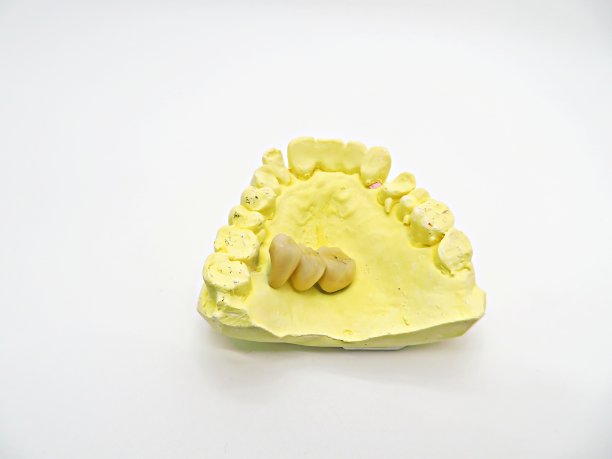 牙科3单元桥图片下载