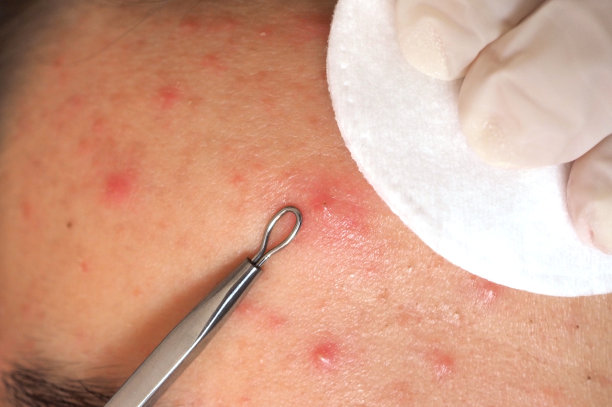 美容师用维达尔环做面部清洁图片下载