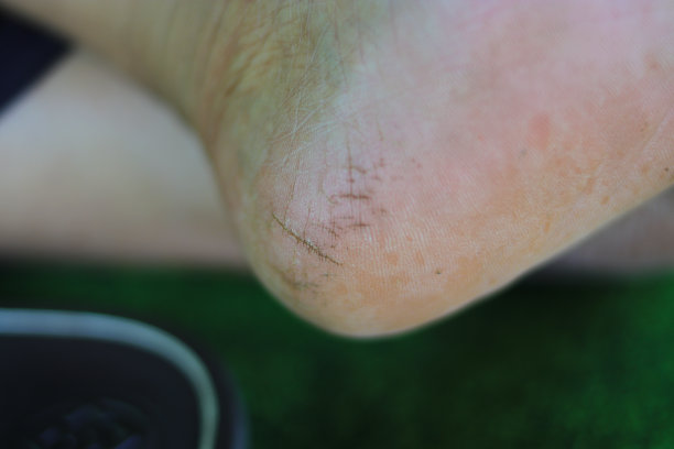 鞋跟裂纹的选择性聚焦图片下载