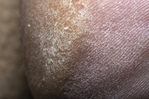 近距离的粗糙的男性皮肤在脚跟。高倍率软聚焦医学及皮肤科专题照片。图片下载