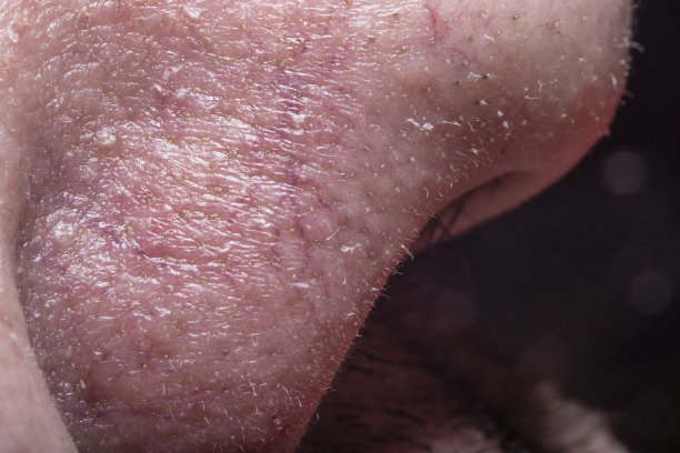 特写的男性鼻子与油性毛孔，明亮的静脉和受损的皮肤。用高倍率软聚焦拍摄。图片下载