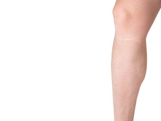 女孩腿上的伤疤特写。腿部受伤处的静脉曲张呈白色孤立背景图片下载