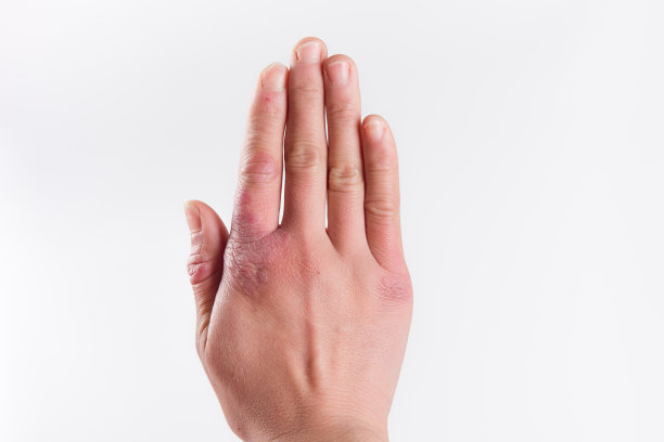 白色背景的女性手部有冻疮皮炎图片下载