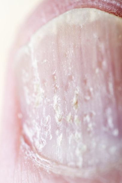 牛皮癣的指甲特写图片下载