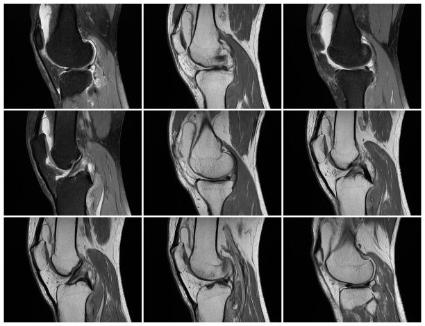 磁共振成像，MRT膝关节成像。急性银屑病性关节炎。左膝关节及周围滑膜液过多图片下载
