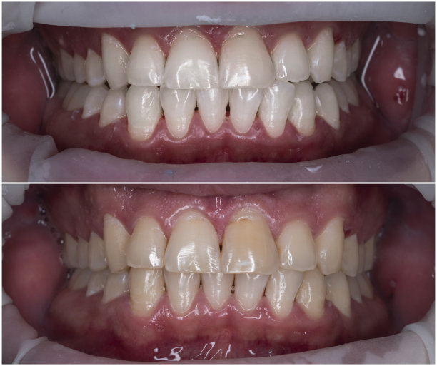 牙齿美白前后图片图片下载