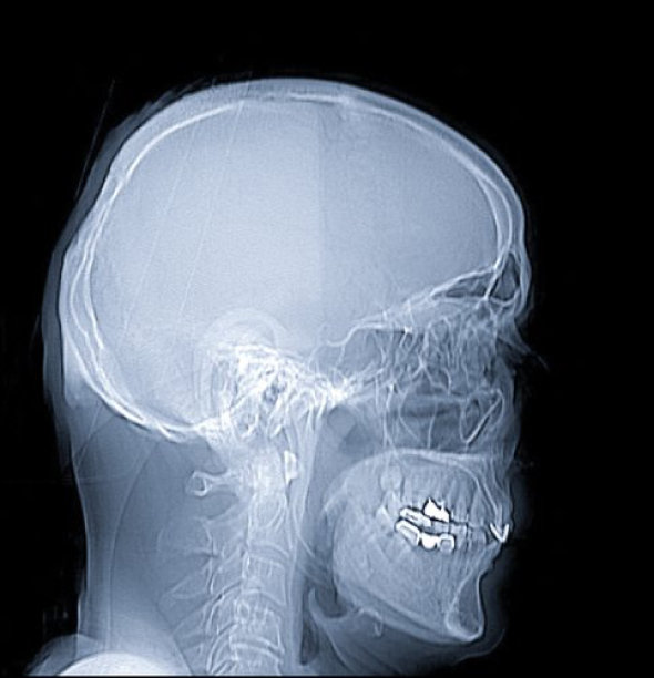 人类头骨x光图像在黑色上孤立图片下载
