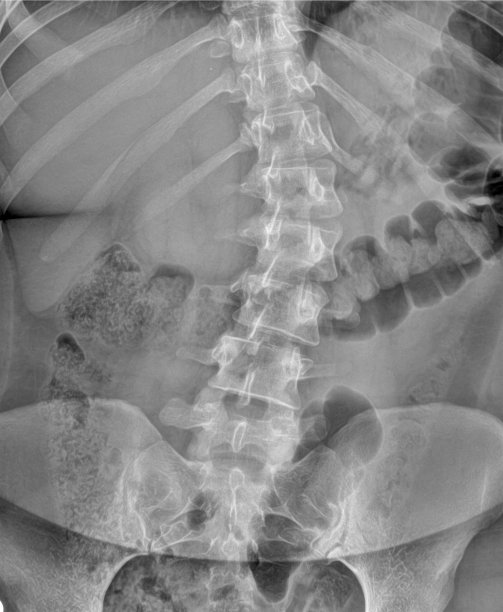 脊柱侧弯患者的腰椎前后位X光片图片下载