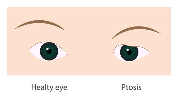上睑下垂。正常的眼睛和下垂的上眼睑插图。图片下载