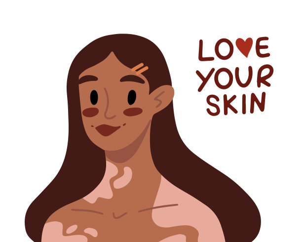 年轻深色皮肤的白癜风妇女。支持患有慢性皮肤病的人。美是多样性。自我接纳，自爱的概念。海报，横幅，卡片国际白癜风日图片下载