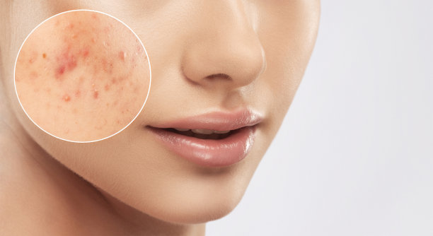 一个皮肤有问题的年轻女孩。痤疮治疗前后照片。图片下载