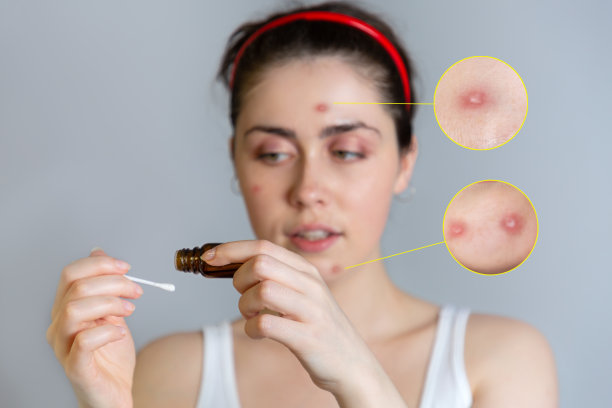 年轻美丽的女人与丘疹在她的脸上，拿着棉签和滴在她的痤疮药。放大的粉刺图片。青春痘、成长、美容的概念图片下载